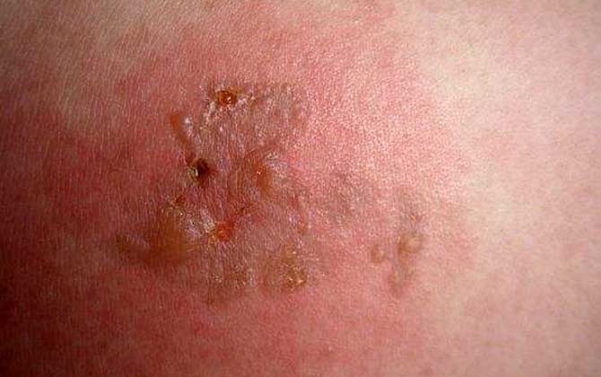 地雷蜂咬人傷口圖片及處理方法 地雷蜂